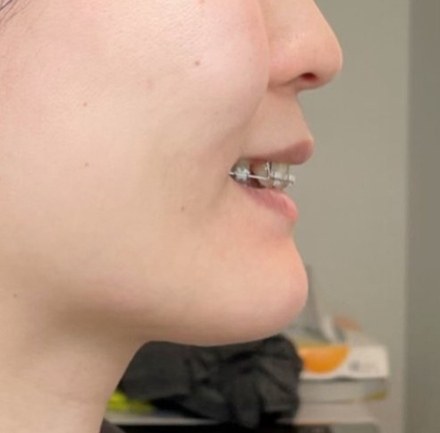 「こんなに変わるの!?」「めっちゃ綺麗！」　人気YouTuber、3年間の“歯列矯正ビフォーアフター”で垢抜け美女に大変身