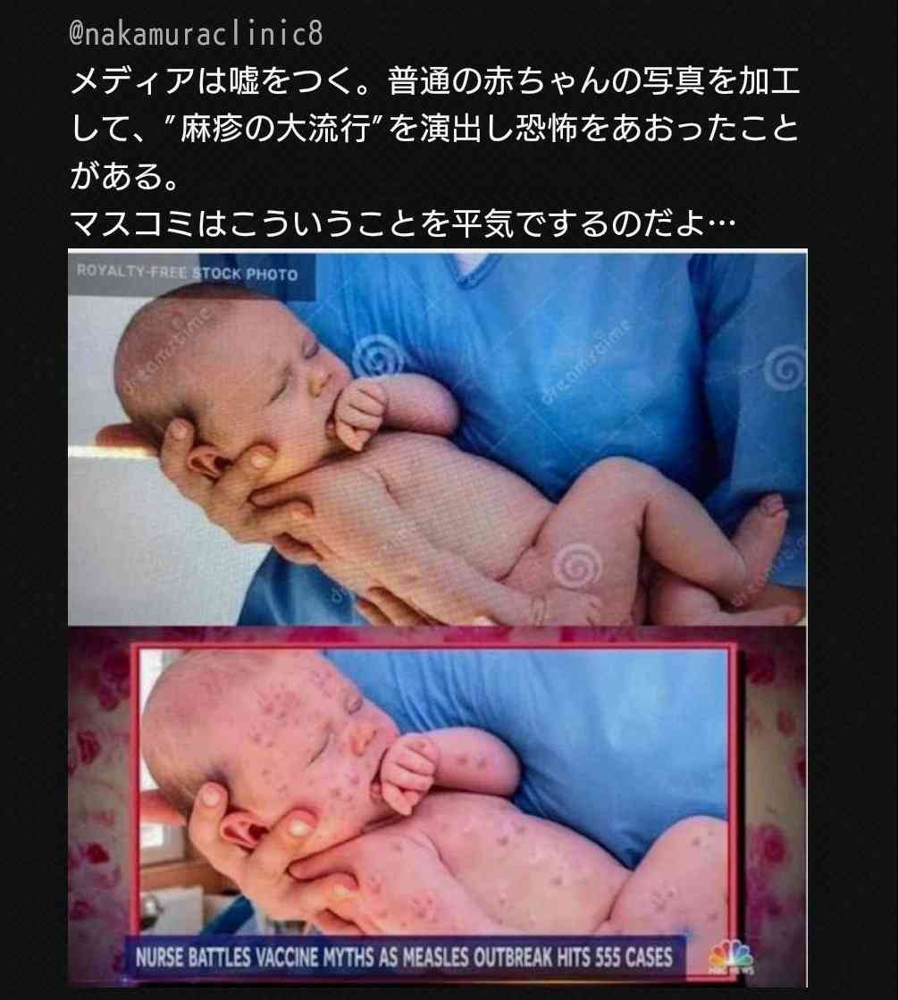 はしか、都内での感染者を確認　世界各地で流行