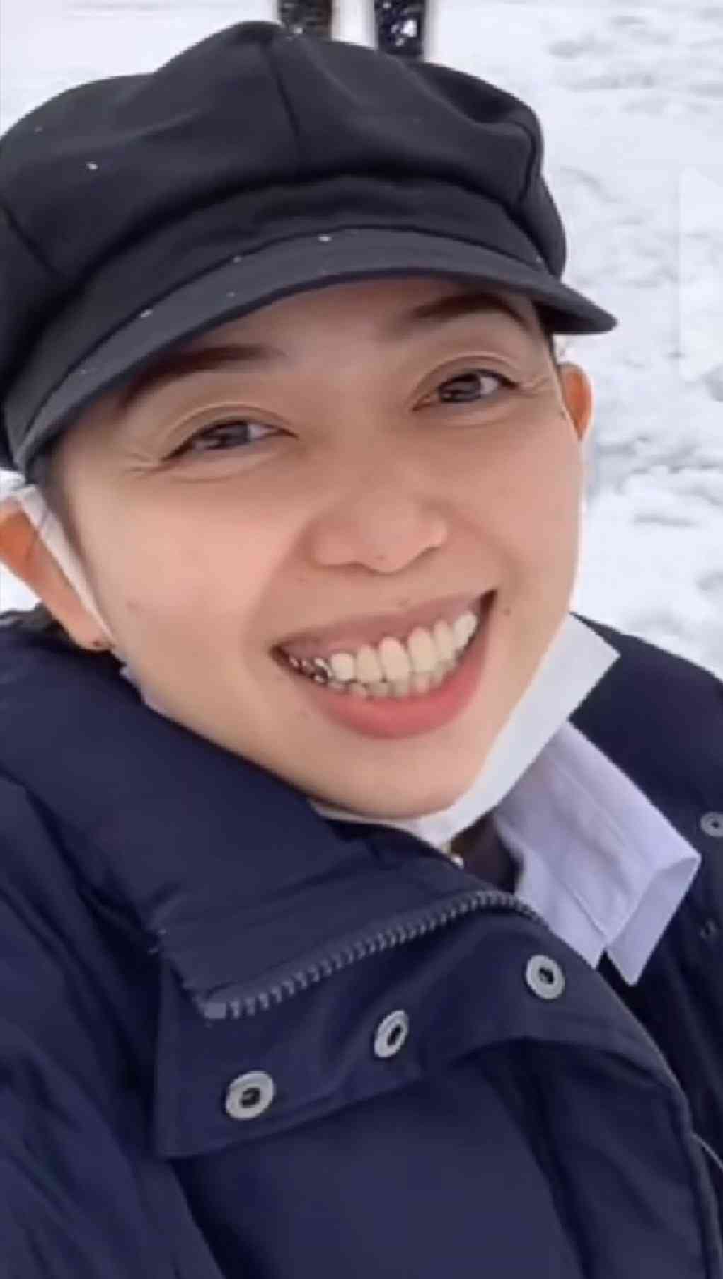 銀歯は印象がマイナス?