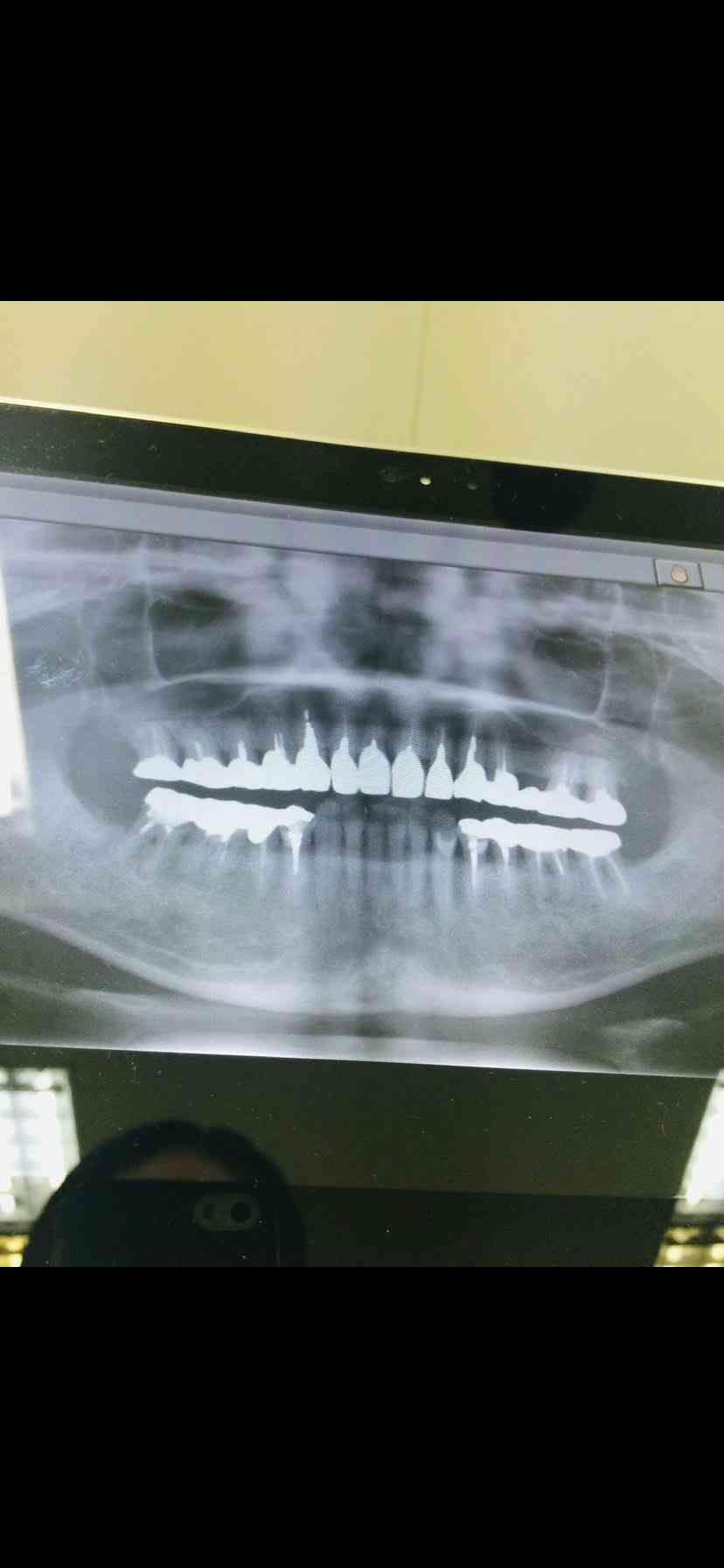 銀歯は印象がマイナス?