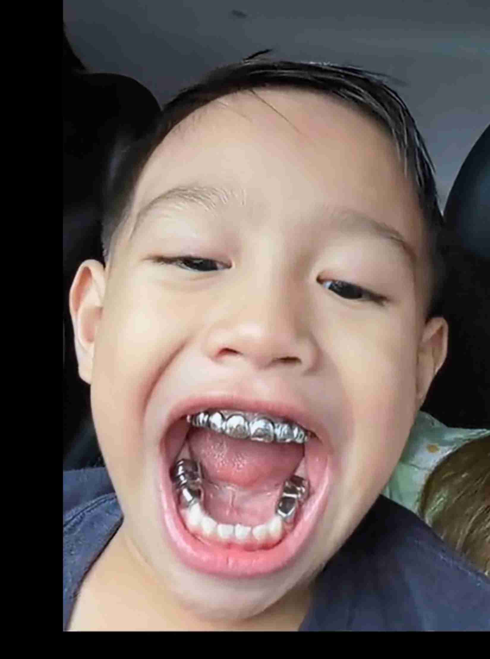 銀歯は印象がマイナス?