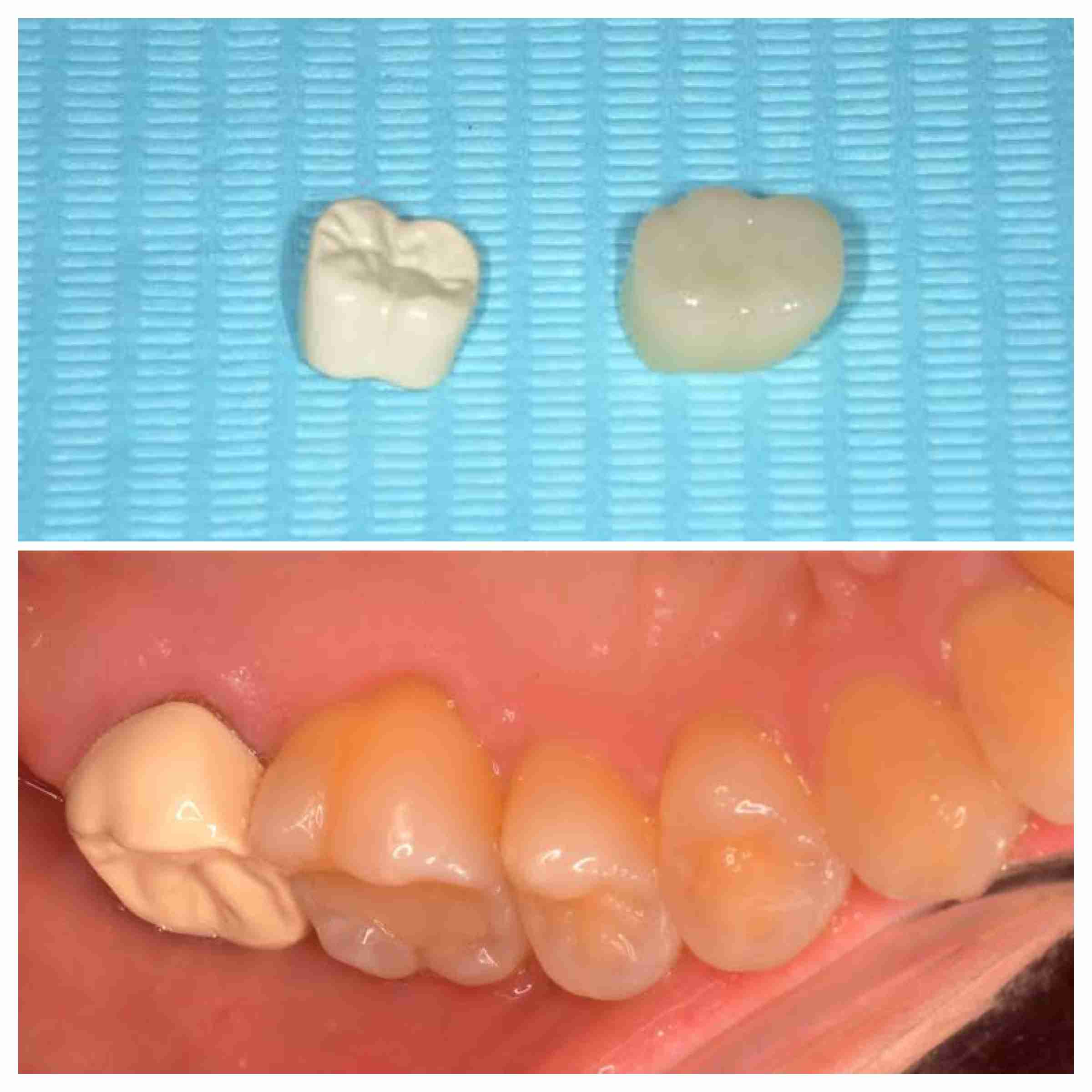 銀歯は印象がマイナス?