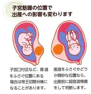 子宮筋腫持ちで妊娠中あるいは出産された方