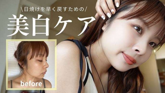 【後悔】日焼けで赤くなる体質なのにUV対策しなかった...