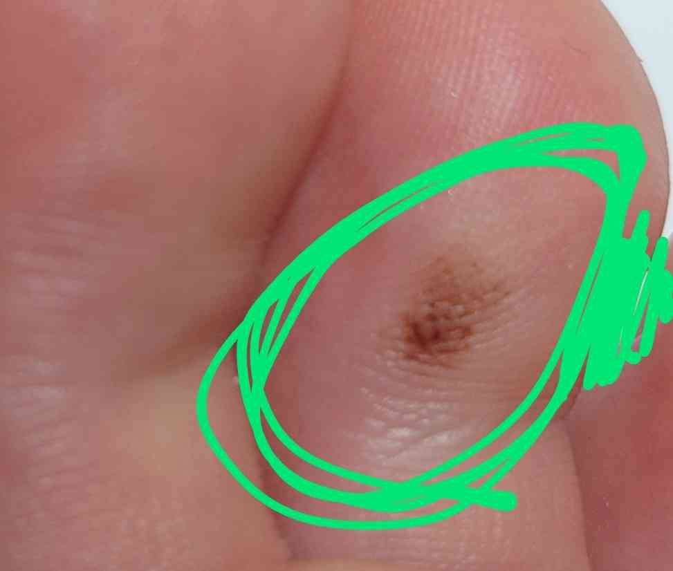 足の裏のホクロ→検査で「皮膚がん」　人気YouTuber「おや？と思ったら皮膚科に」