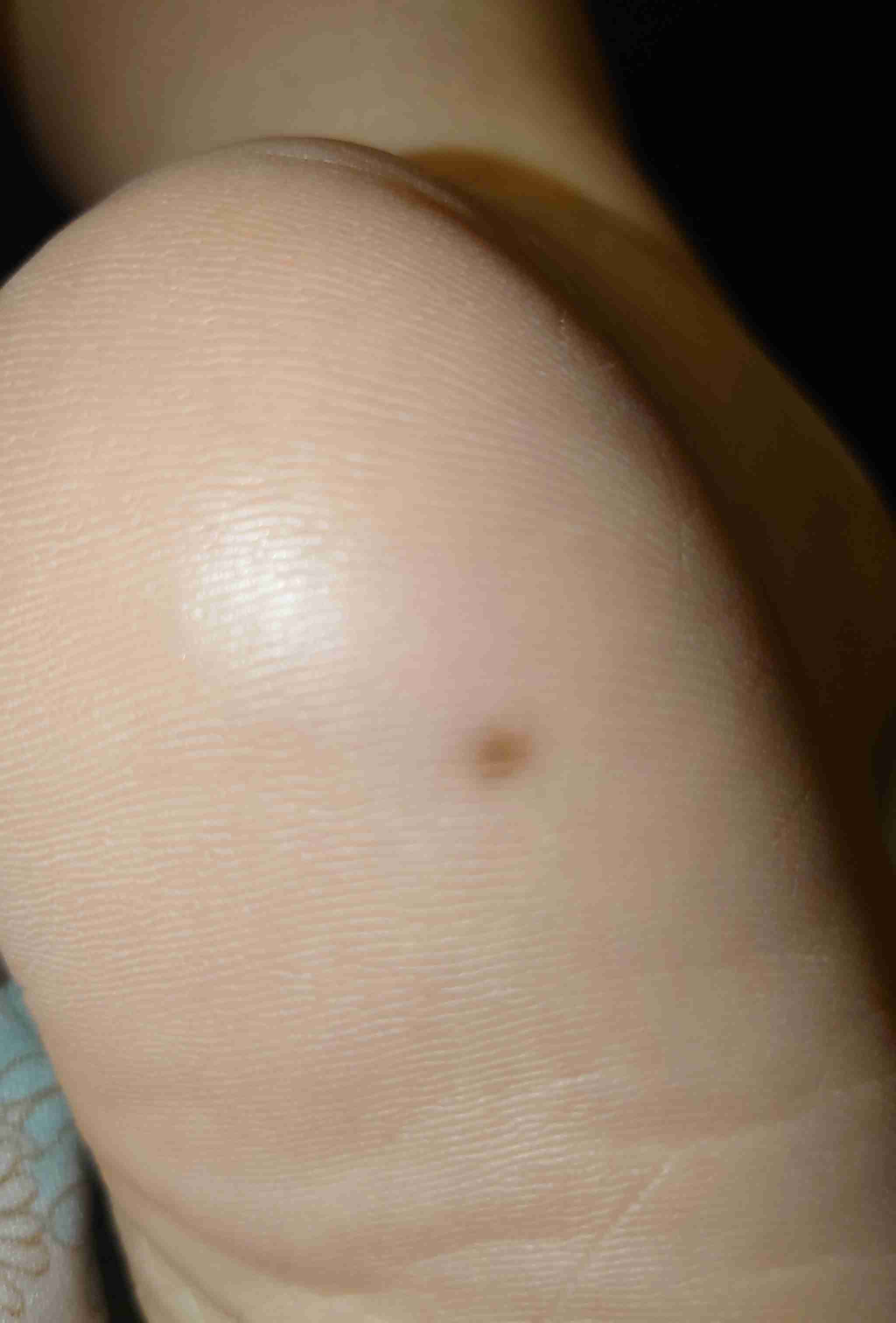 足の裏のホクロ→検査で「皮膚がん」　人気YouTuber「おや？と思ったら皮膚科に」
