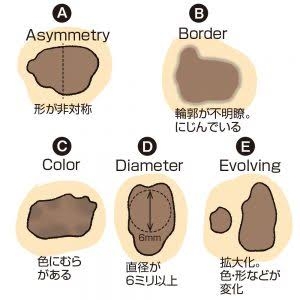 足の裏のホクロ→検査で「皮膚がん」　人気YouTuber「おや？と思ったら皮膚科に」