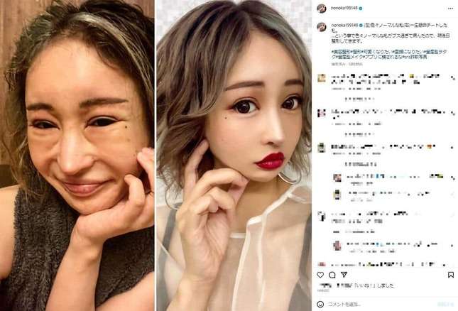 整形してる方、正直おいくら使いましたか？