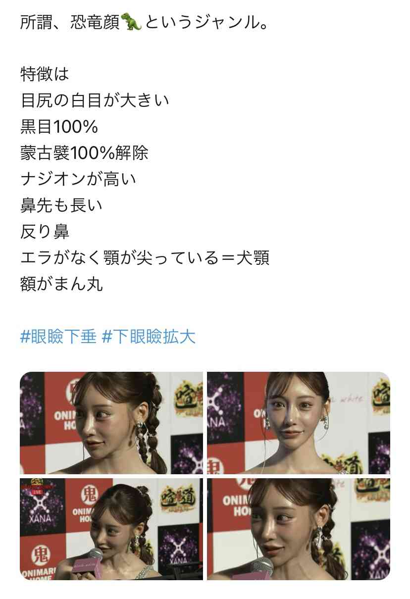 「年7億円」売上話題の人気キャバ嬢、整形手術後の「new鼻」披露 「クソコメ」は「うざい」と突き放す