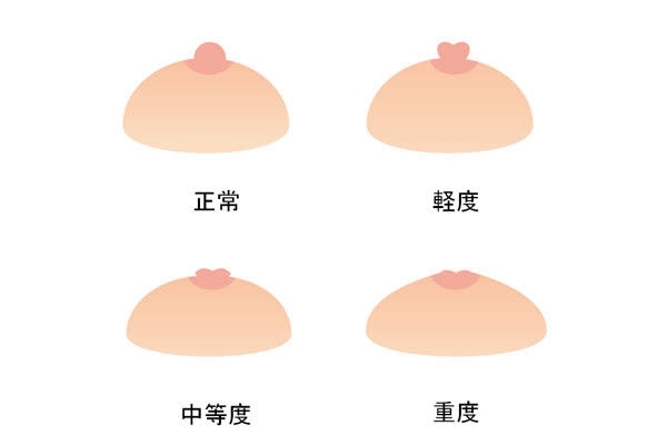 陥没乳頭の方