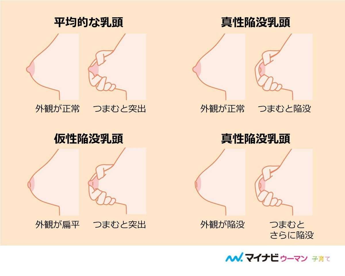 陥没乳頭の方