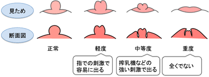 陥没乳頭の方