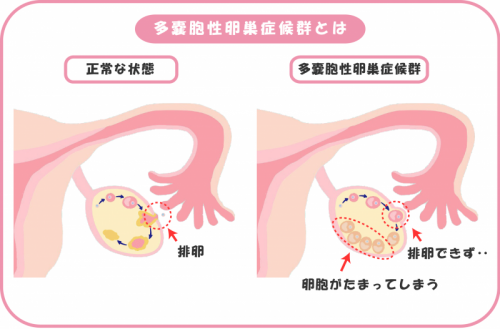 多嚢胞性卵巣症候群の方