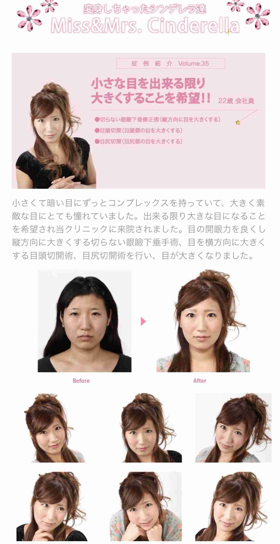 【整形】目頭切開経験者、施術予定の方