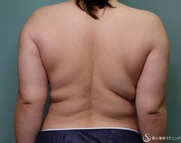 〈脇肉〉目指せ!背中のダイエット〈肩肉〉