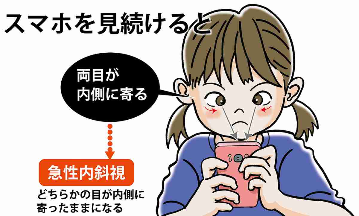 子どもの近視は小1~進行に注意を…視力0.3未満は小1約1%も中3では約3割に 文科省が実態調査
