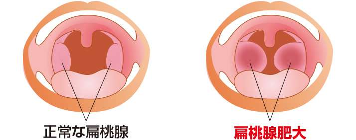 膿栓(臭い玉)を取りたい!!!