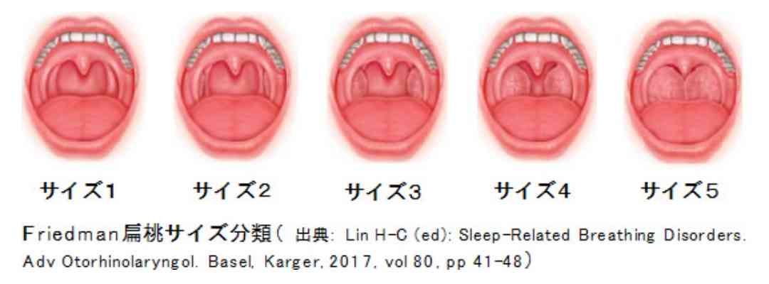 膿栓(臭い玉)を取りたい!!!