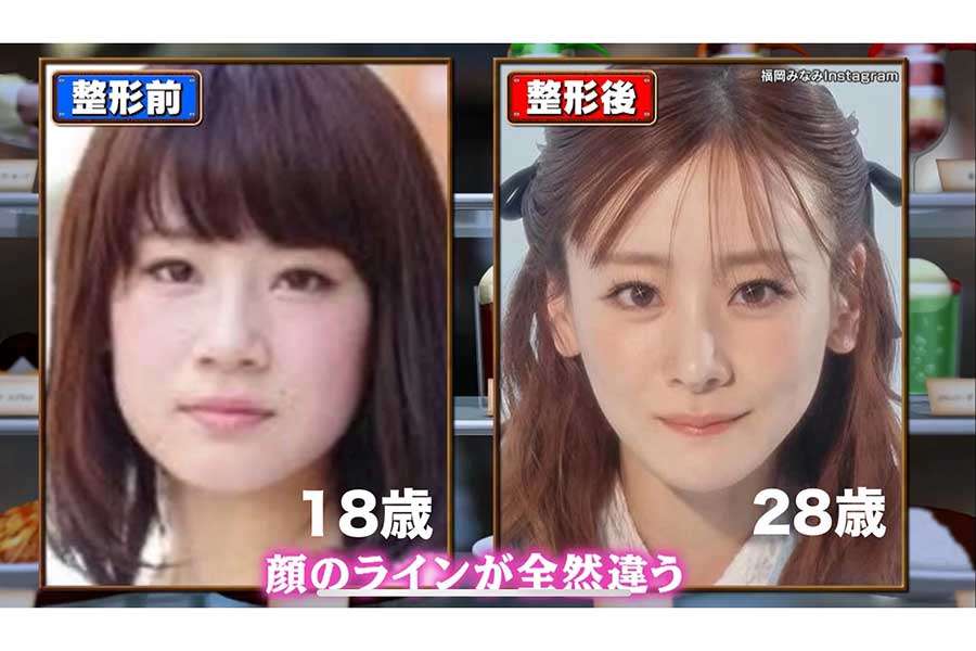 “顔の全パーツ整形済み”の福岡みなみ「すればするほど変な顔になる」　美容整形について率直な心境を告白