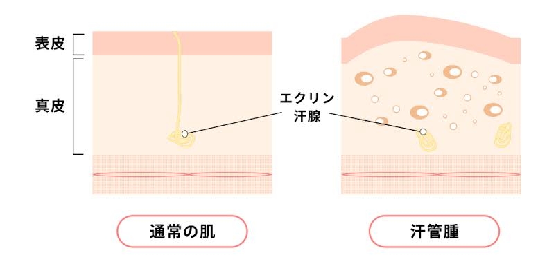 汗管腫(目と身体)で悩んでる人いますか?