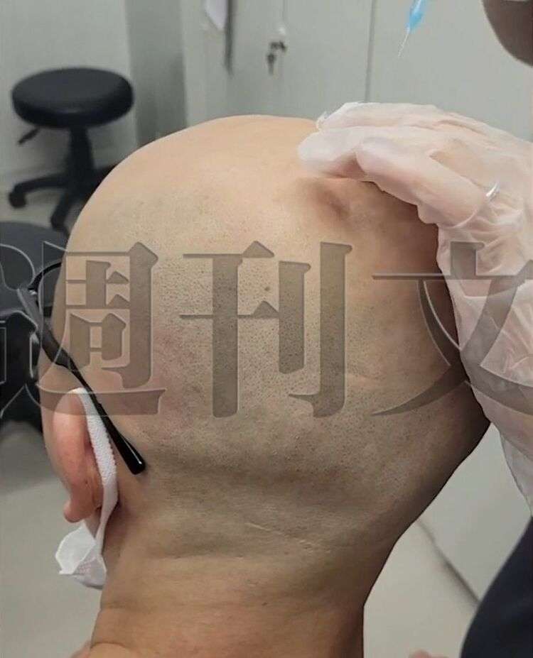 爆笑しながらスキンヘッドに注射…美容外科大手・TCB「医師の悪ふざけ動画」が流出！　看護師「ヤバいなと思った」《不適切動画入手》