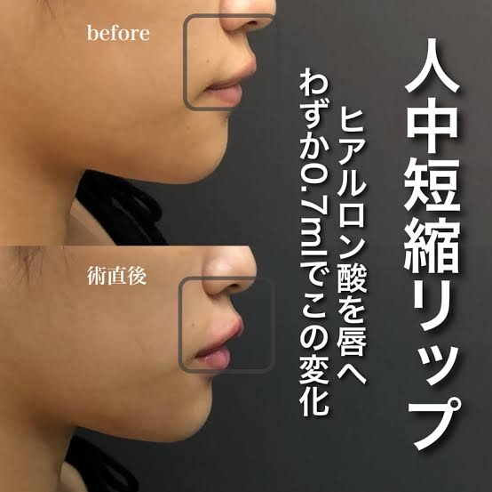 人中短縮ボトックス、唇にヒアルロン酸注射やったことある方！