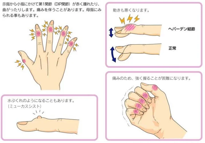 【手指変形】へバーデン結節