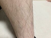 多嚢胞性卵巣症候群の方(PCOS)