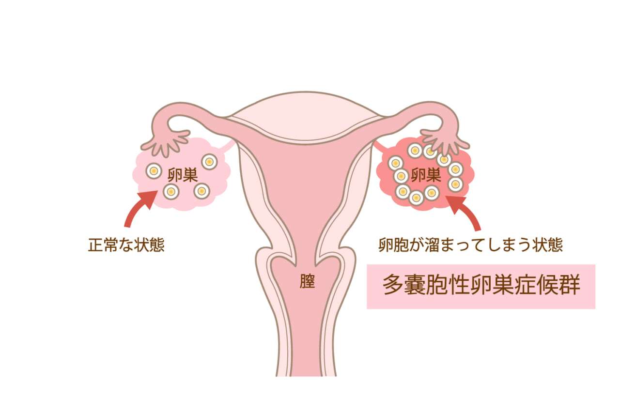多嚢胞性卵巣症候群の方(PCOS)