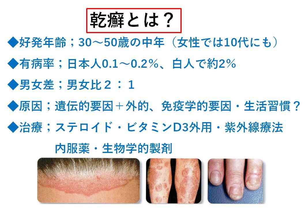 乾癬で悩んでます