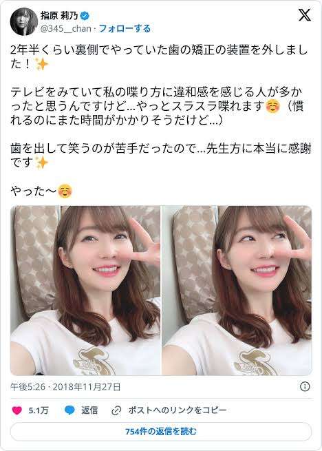 裏側矯正した・してる人【歯列矯正】