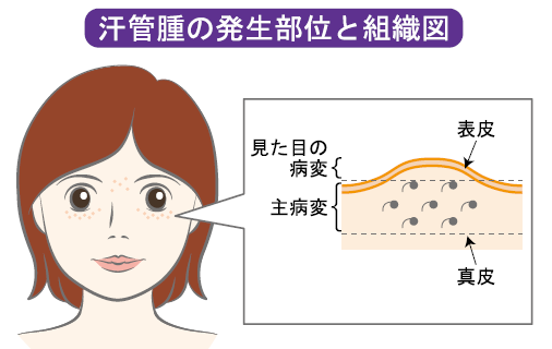 汗管腫ある人!