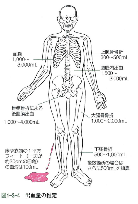 14歳の筋ジストロフィー入所児童をストレッチャーに移す際に転落…左大腿骨骨折、翌日に死亡　鳥取県が謝罪　ストッパーかけていなかった