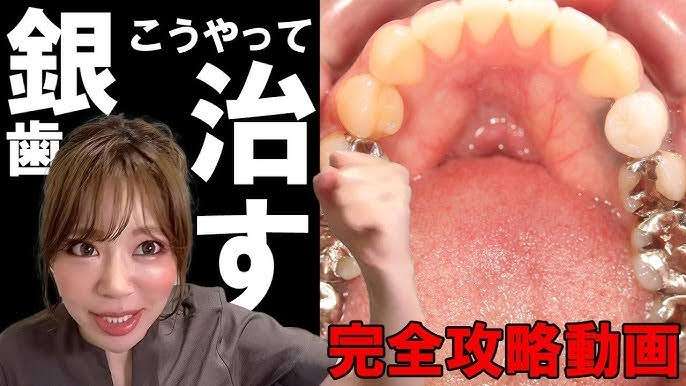 銀歯を外して治療したほうがいいのか