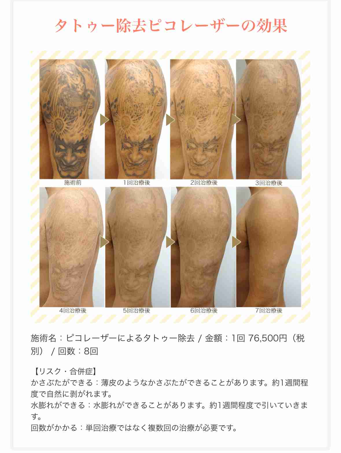 タトゥー・刺青除去専門医が明かす患者の十人十色なワケアリ事情…「推し変したので消したい」「憎い人間を足裏に入れて毎日踏んだけど…」