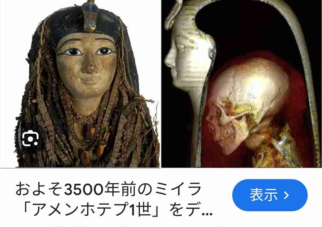 「赤ちゃんの頭の形が気になる」 ヘルメットで矯正の外来に受診者急増　生後6か月までに始めると効果的　広島大学病院