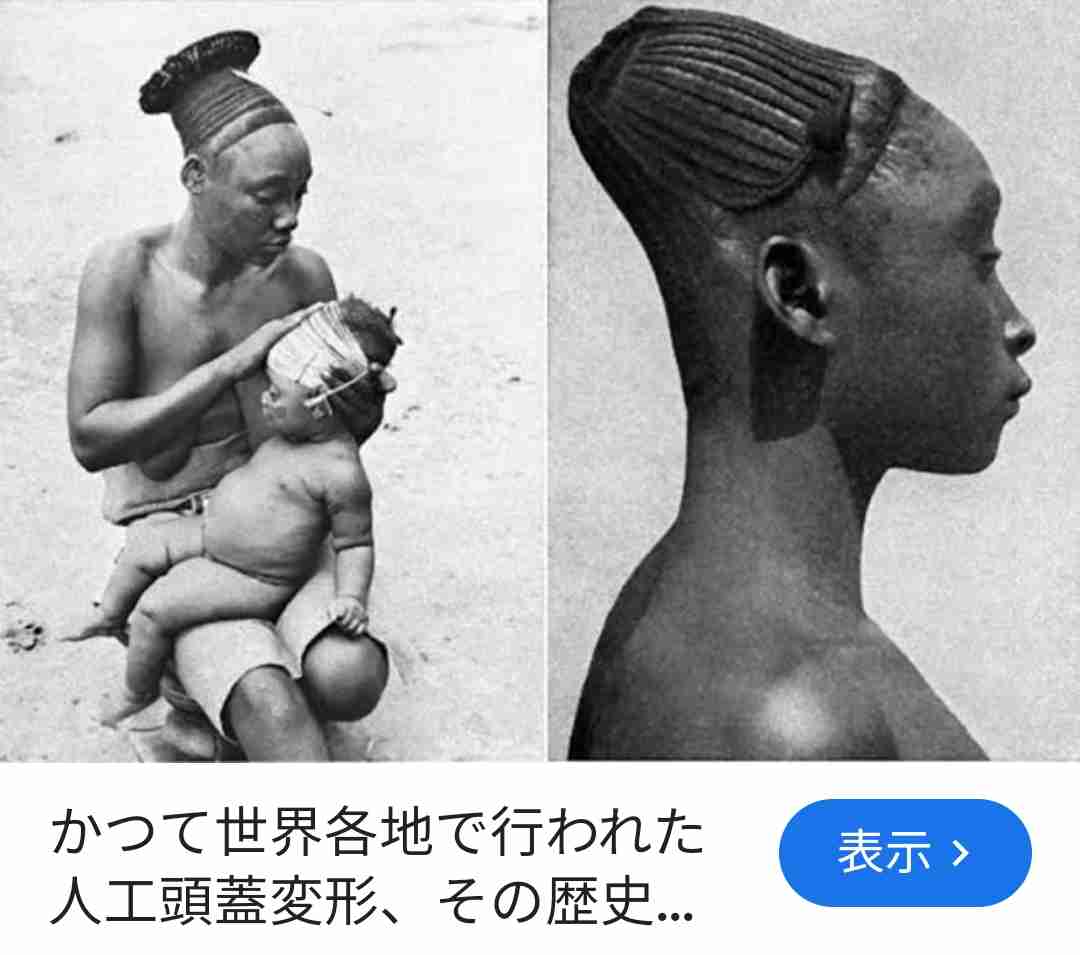 「赤ちゃんの頭の形が気になる」 ヘルメットで矯正の外来に受診者急増　生後6か月までに始めると効果的　広島大学病院