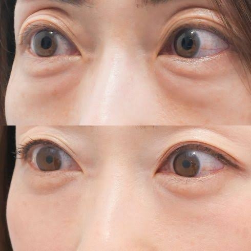 旦那に内緒で美容整形したい