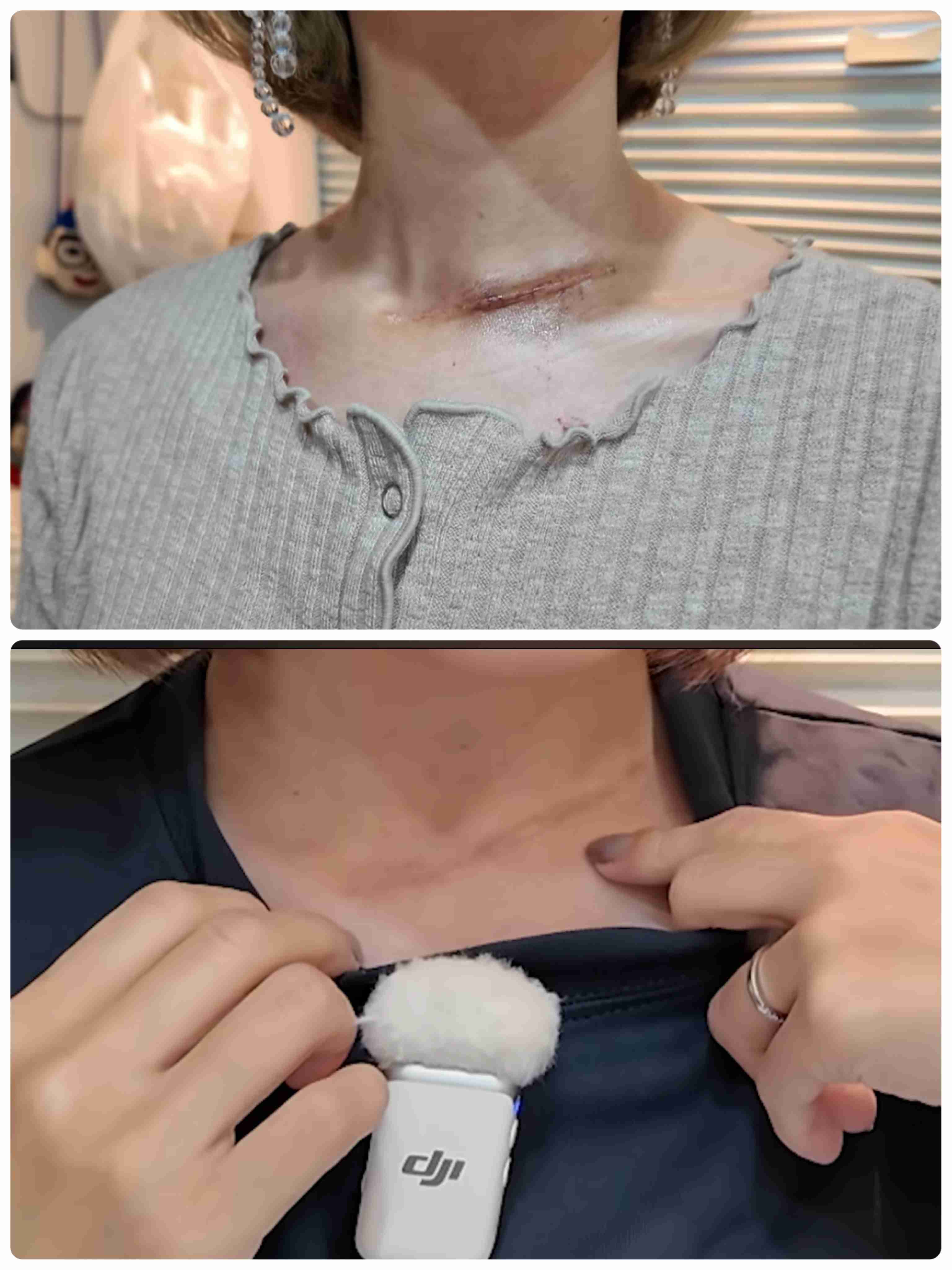 すい臓がん公表ユーチューバー　がんの肺転移を報告　夫は悲痛「考えられる限り最悪の形だった」