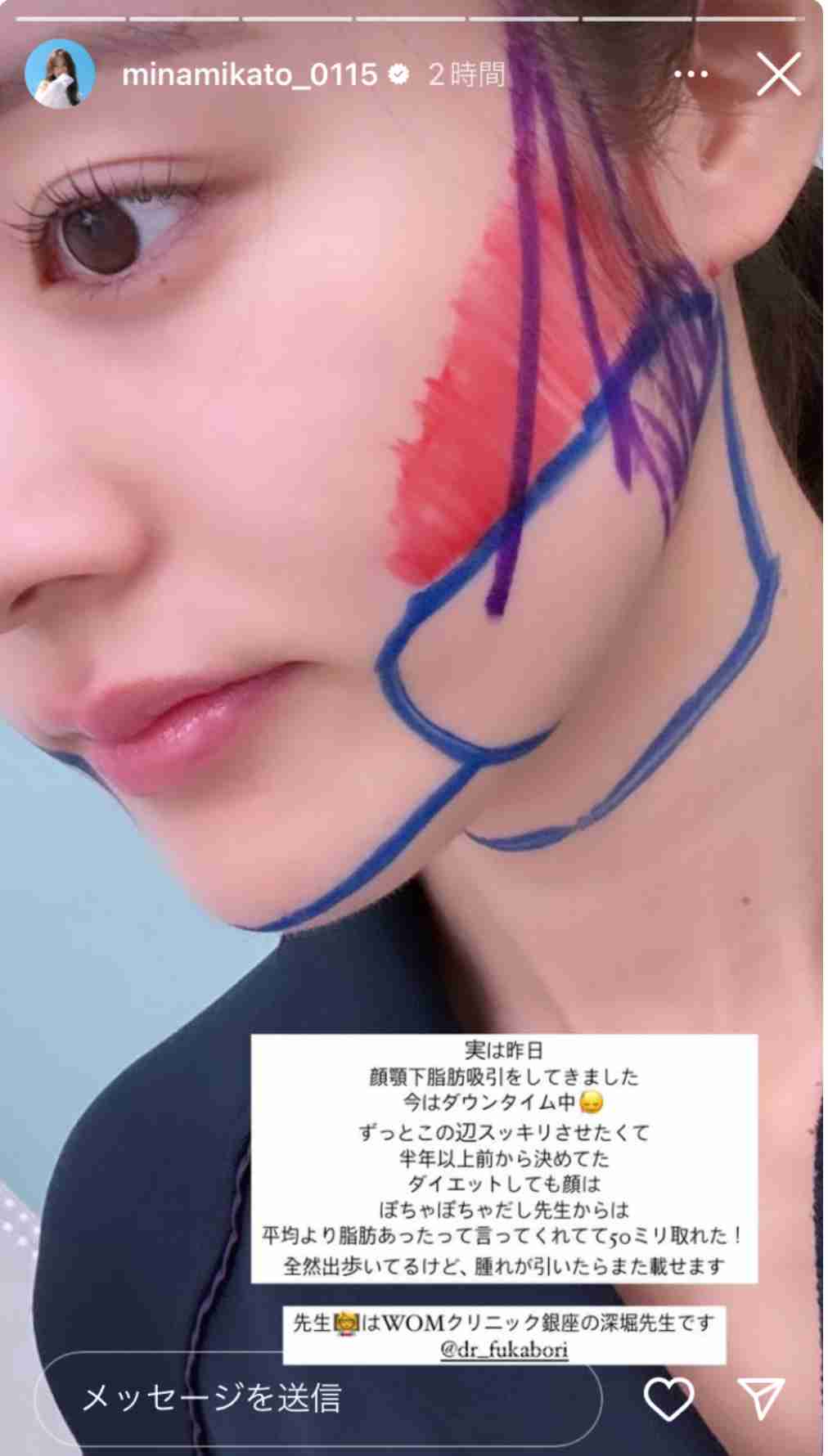 元NGT48メンバーが整形箇所と総額を赤裸々告白「高かったんですけど、早めに可愛くなってうれしい」