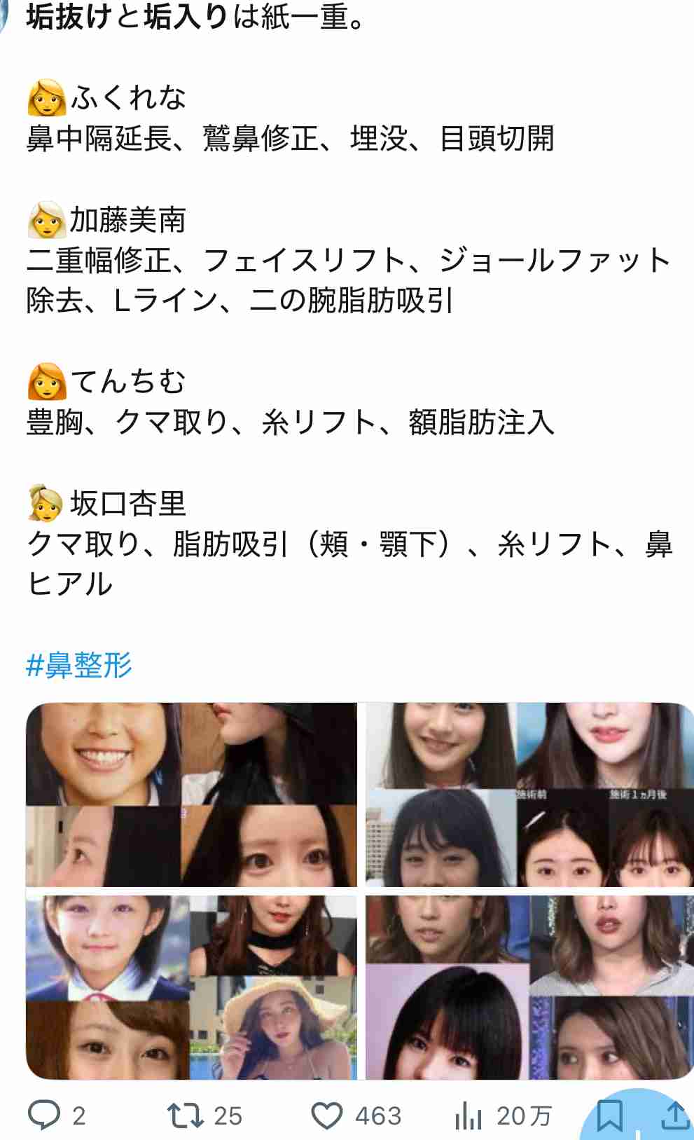 元NGT48メンバーが整形箇所と総額を赤裸々告白「高かったんですけど、早めに可愛くなってうれしい」