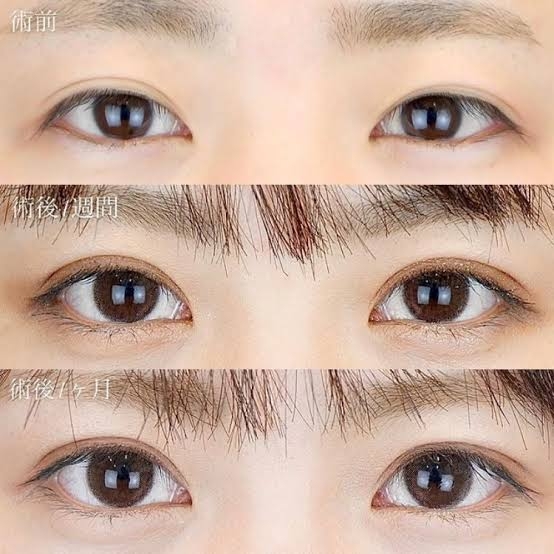 30代後半で埋没