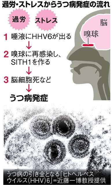 “認知症発症関わるたんぱく質”うつ病患者の脳に高割合で蓄積