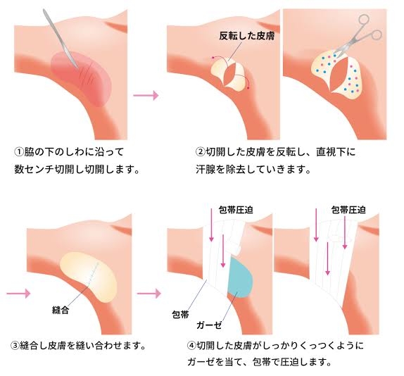 相手を傷つけずにワキガを指摘する方法教えて下さい！
