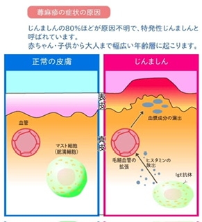 原因不明の蕁麻疹が辛い