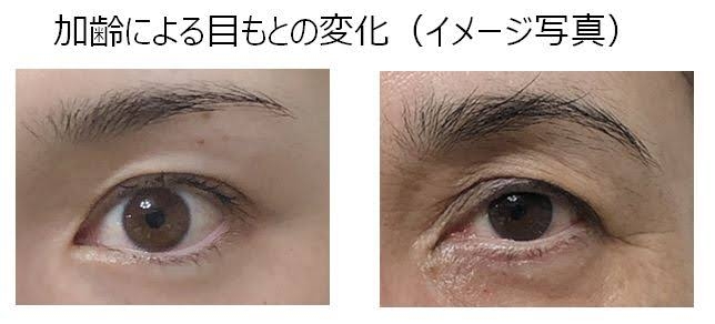 整形無しで加齢による瞼のたるみ対策