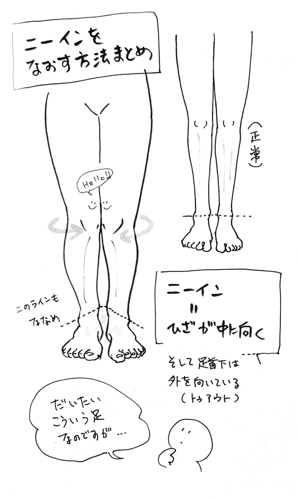 寝指(足の小指のねじれ)