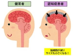モラハラ？認知症の前兆？同じ事を何度も言う義父