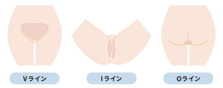 VIO脱毛してますか?