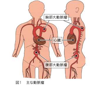 脳動脈瘤ある人
